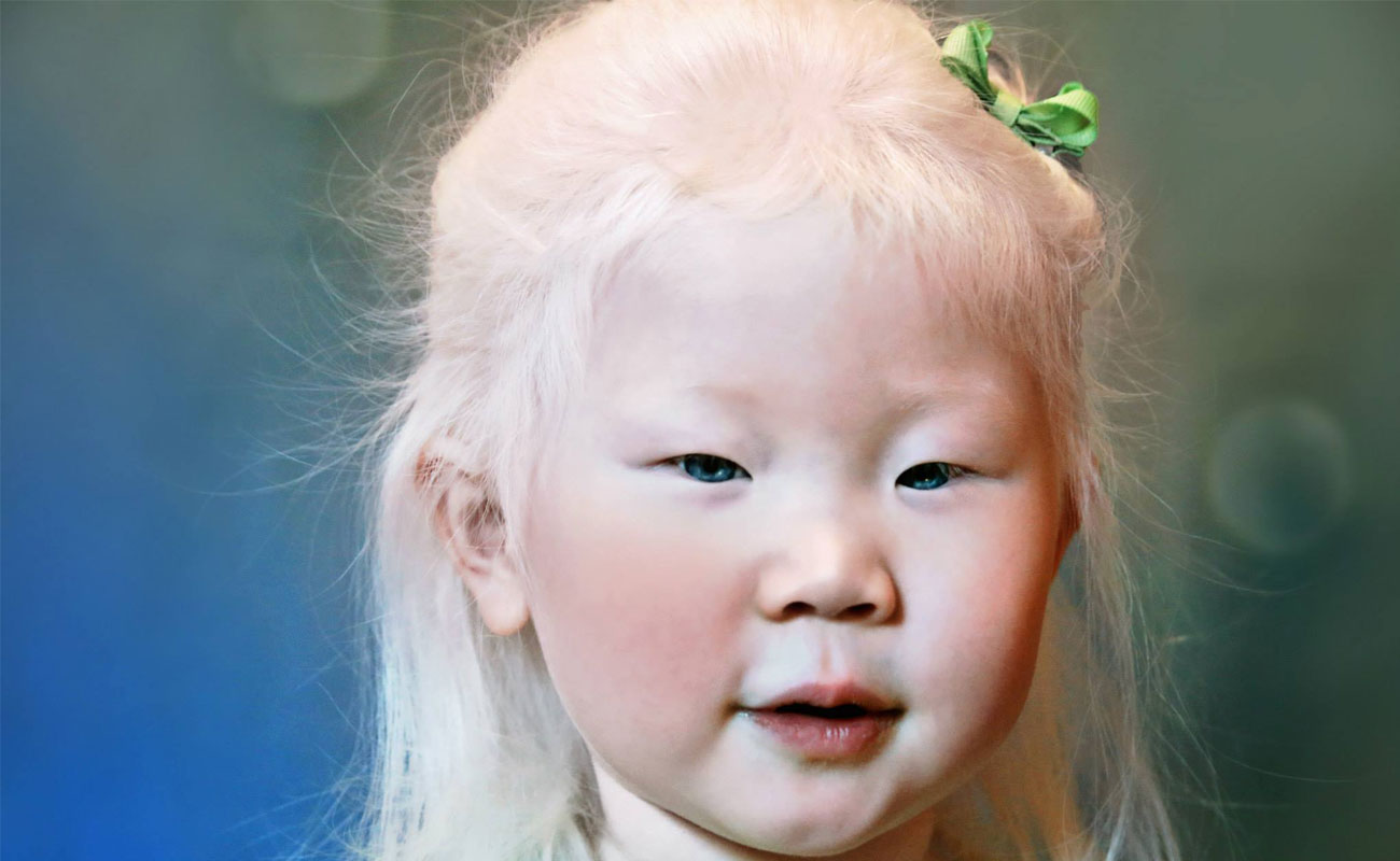 alale.co--Albinism