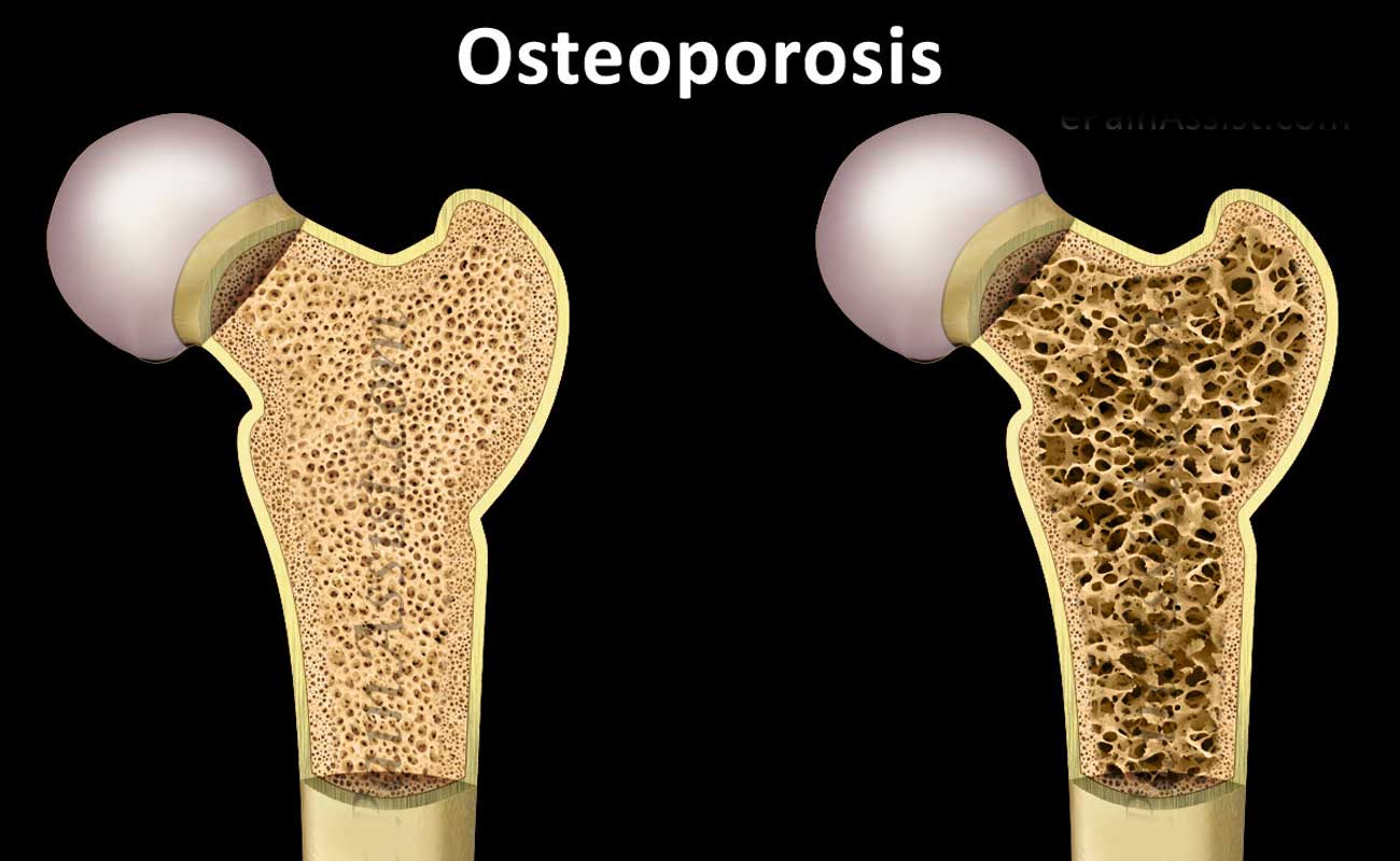 osteoprasis-alale.