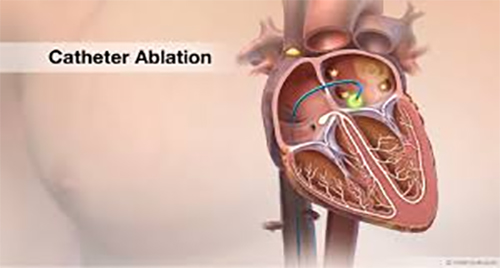 Catheter-ablation-alale