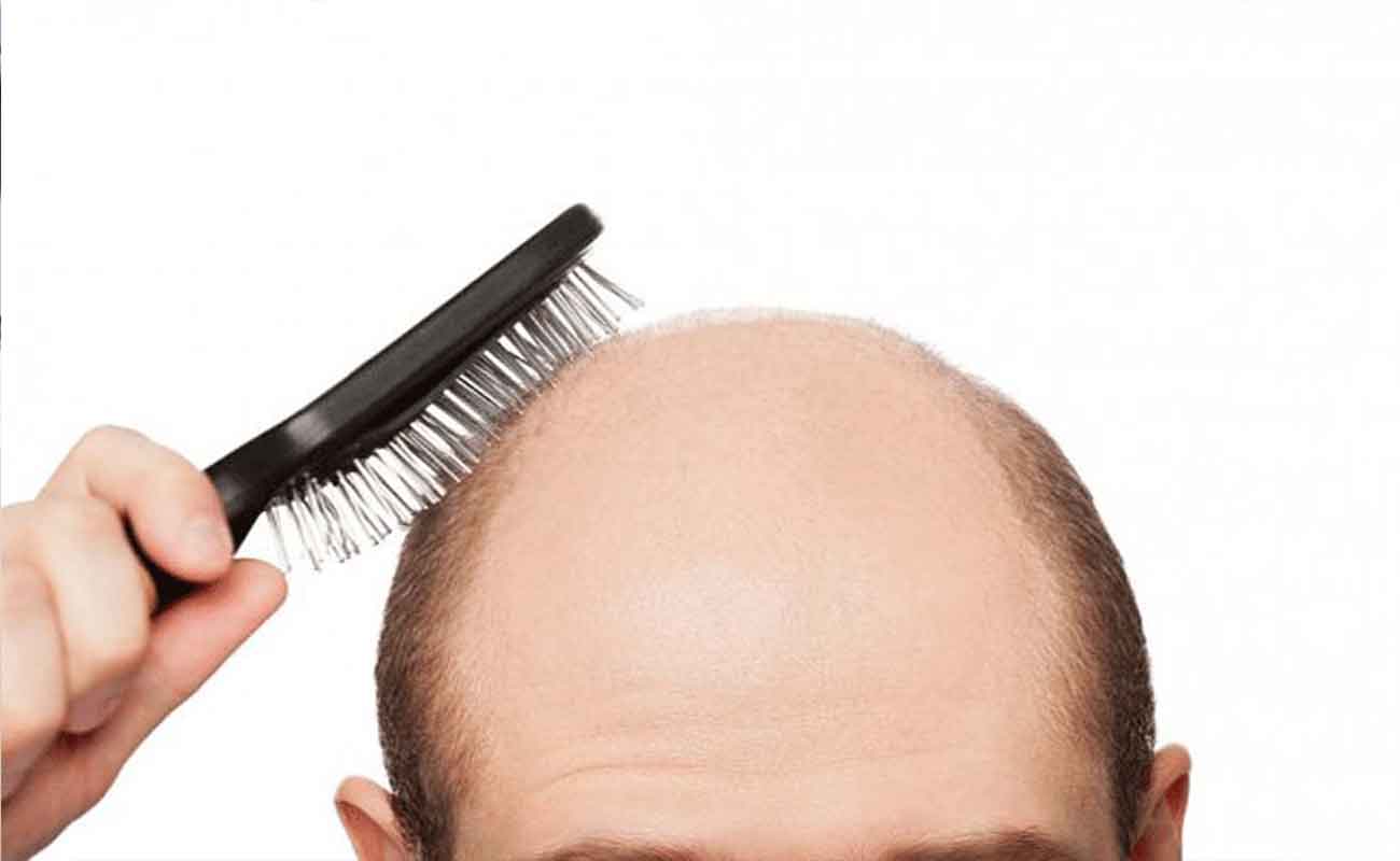 alopecia1-alale.co