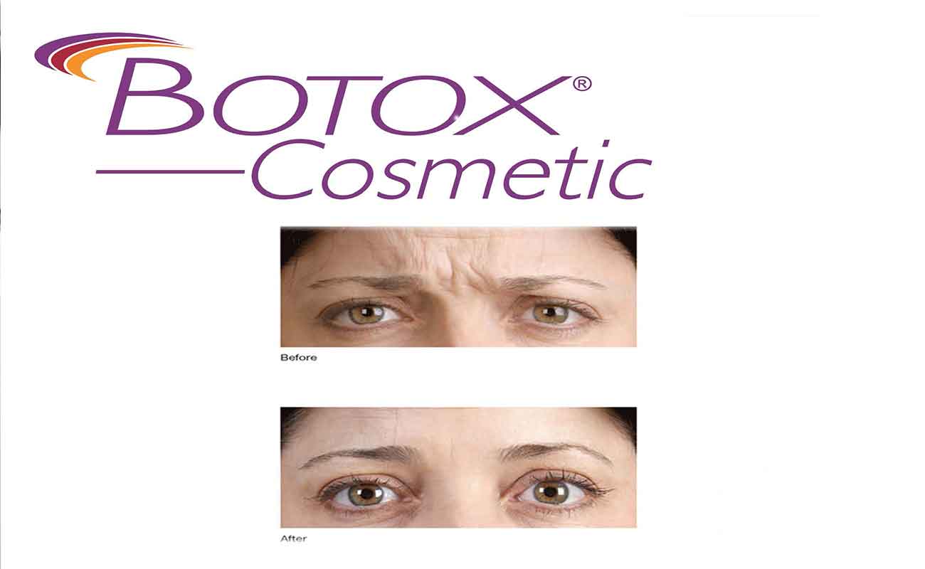 Botox-alale.co.j